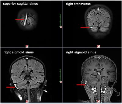 Analysis of 10 Pediatric Nephrotic Syndrome Cases With Complications of Cerebral Sinovenous Thrombosis